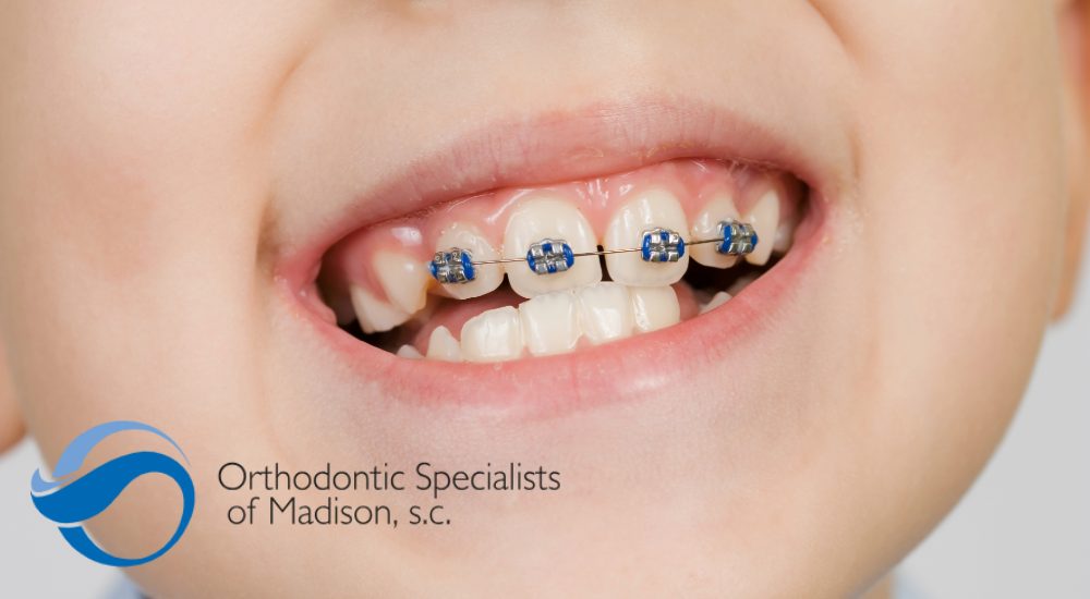 child's teeth with braces